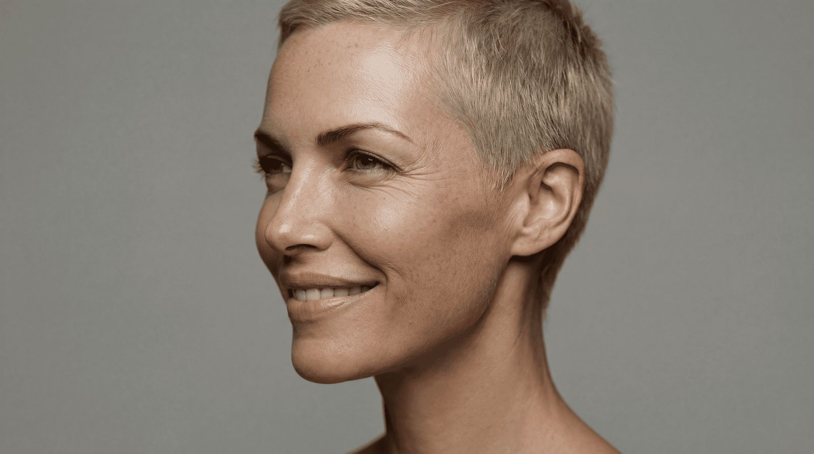 Botox treatment for crow's feet